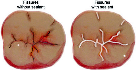 Pit and Fissure Sealants