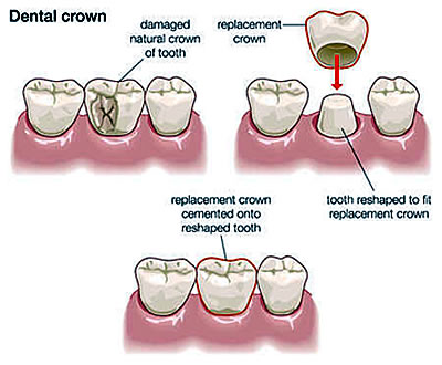 Crowns